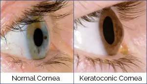 קרטוקונוס קרטוקונוס
